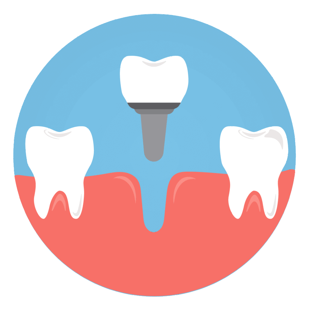 Dental-implant